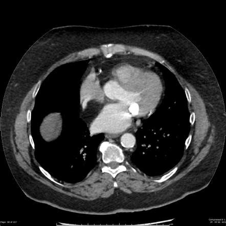 Lipomatous Hypertrophy Of The Interatrial Septum Radiology Reference