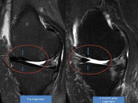 Mri Sagittal T2 View Of The Knee Pre Treatment And Post Treatment Mri