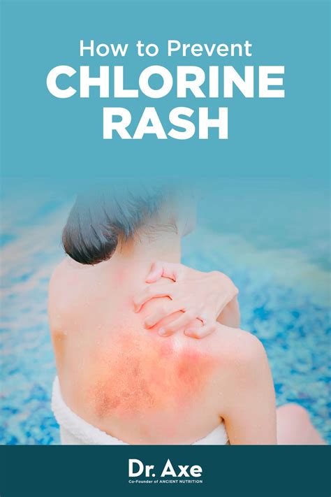 Chlorine Rash Symptoms Causes Treatment And Prevention Dr Axe