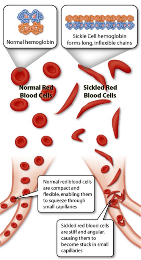 Sgugenetics Genetics Behind Sickle Cell Anemia