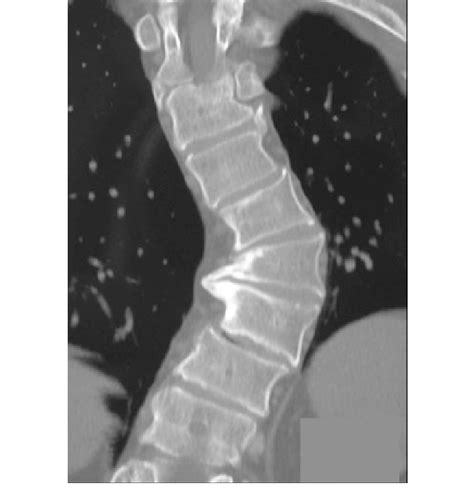 Coronal Ct Scan Section Showing A Left Thoracic Scoliosis With Wedging