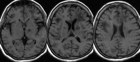 White Matter Disease Mri Mri Lesions Diffuse Axial Diseases Club Center