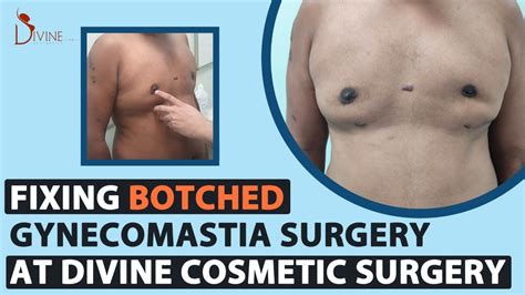 Fixing Botched Gynecomastia Surgery At Divine Cosmetic Surgery Youtube