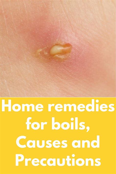 Home Remedies For Boils Causes And Precautions Skin Care Home