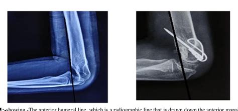 Figure 1 From Surgical Correction Of Post Traumatic Cubitus Varus