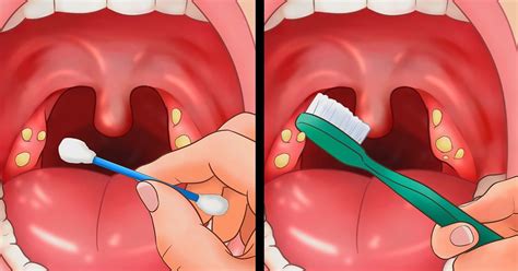 Check spelling or type a new query. 11 Tips for Removing Tonsil Stones That'll Make You Sigh ...