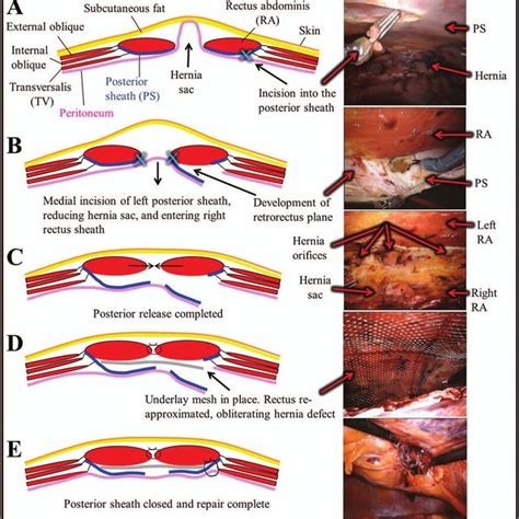 Pdf Ascending The Learning Curve Of Robotic Abdominal Wall Reconstruction