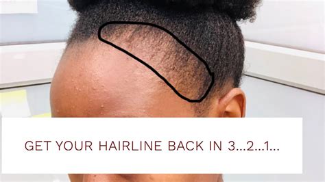 Get Your Hairline Back In 321 Youtube