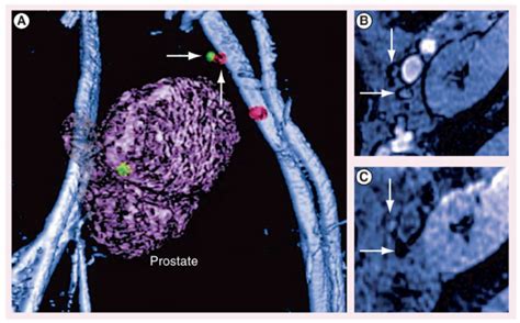 Imaging Lymph Node Metastasis In A Prostate Cancer Patient Download