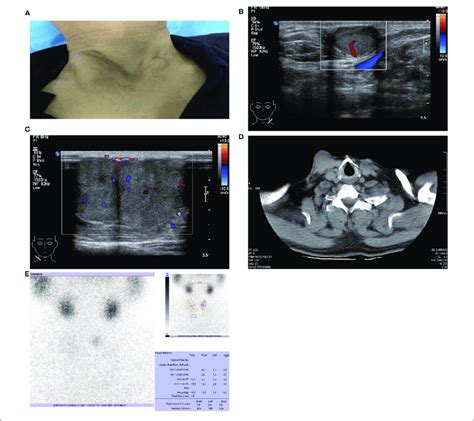 Images Of Patient And Subcutaneous Nodules A Multiple Subcutaneous