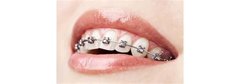 Faqs About Adult Orthodontics China Orthodontic