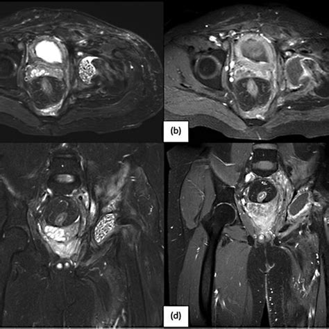 Mri Images Axial T1 Axial T2 Coronal T1 And Coronal