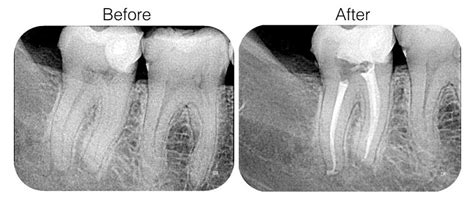 Maybe you would like to learn more about one of these? Root Canals Treatment- Lakeland | Kawveh Nofallah DMD