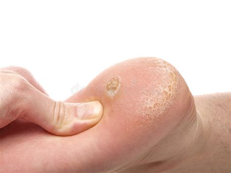 Dry Skin Under Foot Stock Image Image Of Dermatology 38930893