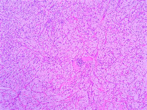 Renal Cell Carcinoma Ug Slide Histopathologyguru