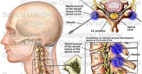 Occipital Neuralgia Cervical Facet Joint Injection Uctdsjogrens