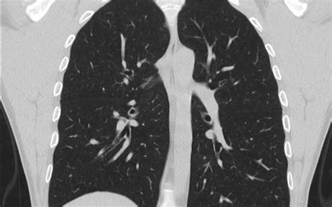 Lung Cancer Pictures Ct Scan کامل مولیزی