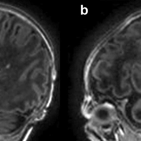 Automatic Detection Of Punctate White Matter Lesions Pwmls In An