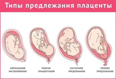 Плацента по передній стінці матки при вагітності | Вагітність