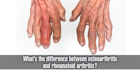 What Is The Difference Between Osteoarthritis And Rheumatism Cureup