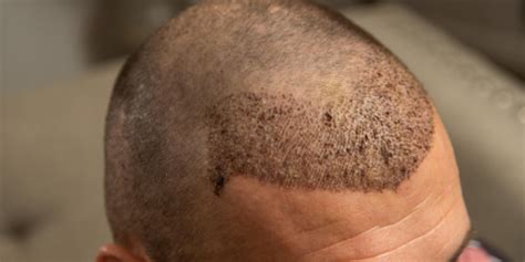 A Guide To Hair Transplant Methods