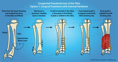 Congenital Pseudarthrosis Of The Tibia International Center For Limb
