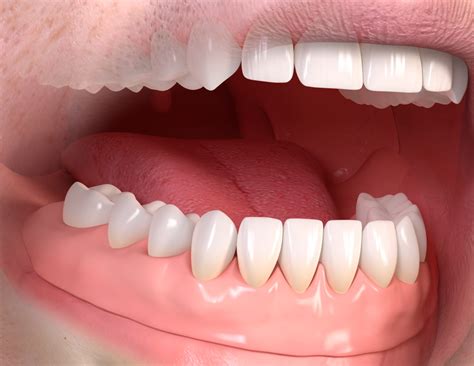 Denture Stabilisation - Goldthorn Dental Practice