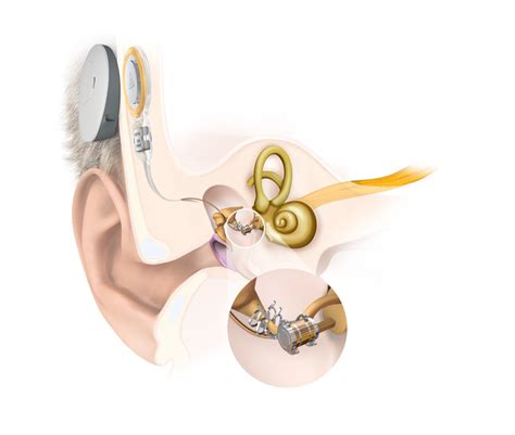 The Vibrant Soundbridge Middle Ear Implant System Med El