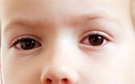 Pink Eye In Toddlers Everything You Need To Know Earth News Report