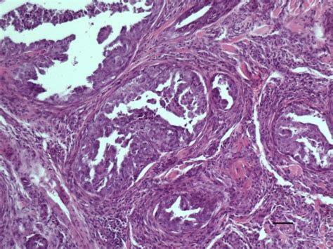 Canine Apocrine Sweat Gland Carcinoma Complex Cystic Papillary Type