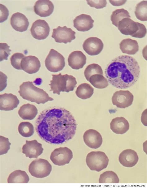 Critical Blue Green Inclusions In Neutrophil And Monocyte Cytoplasm In