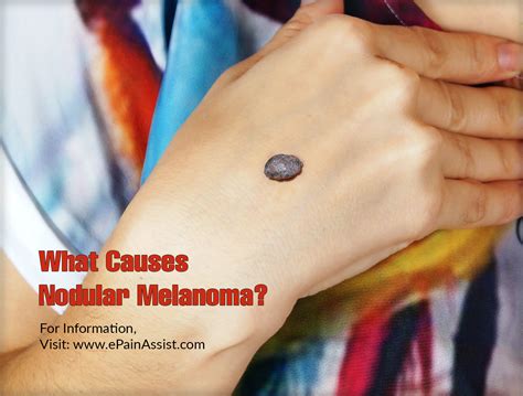 Nodular Melanoma Causes Symptoms Treatment