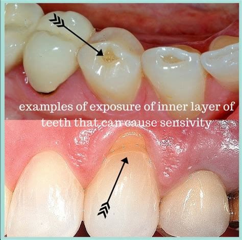 understanding tooth sensitivity palms dentist shirley christchurch dentists
