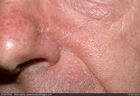 Stock Image Dermatology Seborrheic Dermatitis Dry Red And Inflamed Skin With Flaky Scales