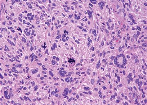 Soft Tissue Sarcomas Of The Abdomen And Pelvis Radiologic Pathologic