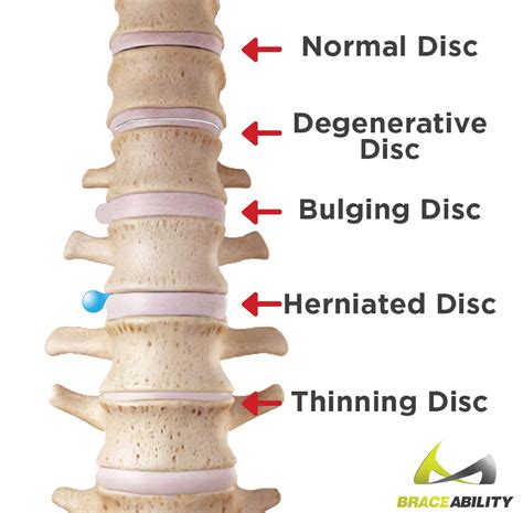Bulging Disc Herniated Disc Lower Back Disk Herniation Bulging Disc