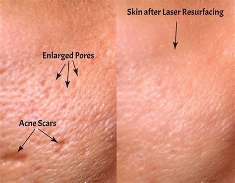 Acne Scar Diagram