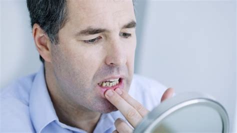 Rak Jamy Ustnej 3 Sygnały Ostrzegawcze Które Mogą Uratować życie