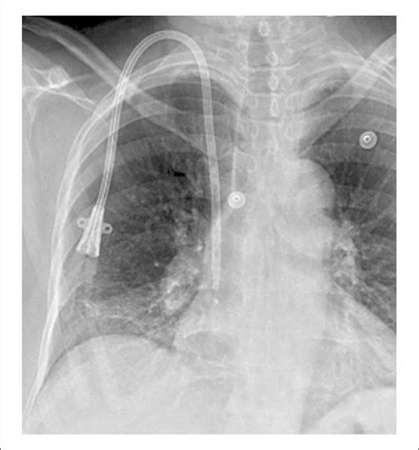 Chest X Ray Shows That The Central Venous Catheter Pa Vrogue Co