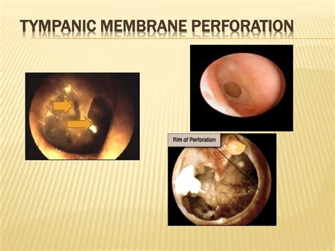 Ppt Otorhinolaryngology Disorders Of The Ear Nose And Throat