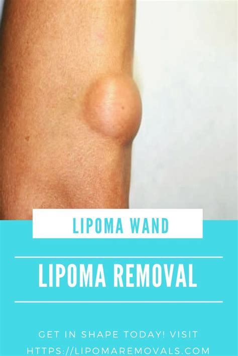 Pin On Lipoma Removals