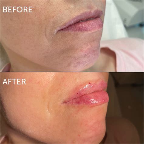 Lip Filler Swelling Stages A Week By Week Guide Dataemia