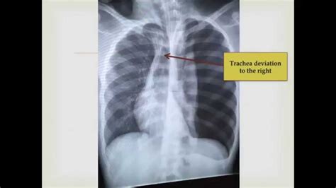 Spontaneous Tension Pneumothorax Cxr Bilateral Sides Youtube
