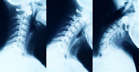 Cervical Instability Causes And Best Treatment Options In 2023