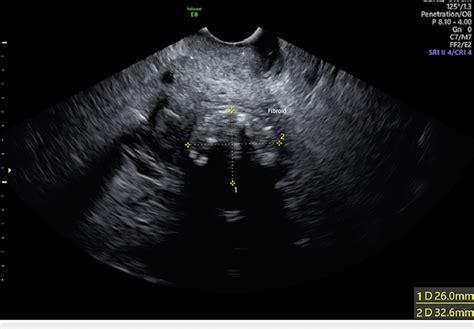 Ultrasound Image Displaying A Small Mass In The Anterior Myometrium