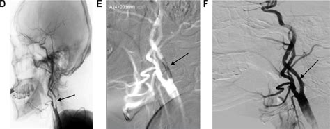 A Stroke Patient Of Right Side Severe Internal Carotid Artery Stenosis
