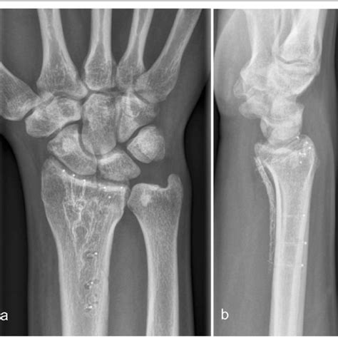 Distal Radius Fracture Treated With A 27 Mm Carbonpeek Plate X Ray 6