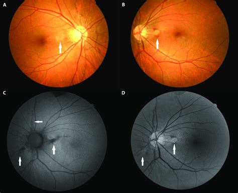Color Fundus Photographs A B Angioid Streaks In Both Eyes White