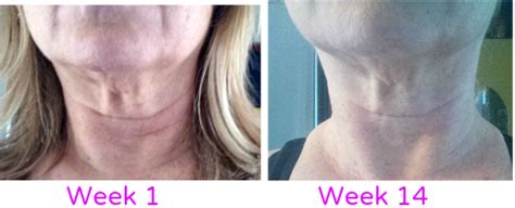 Facial Jowls Get A Naturally Defined Jawline