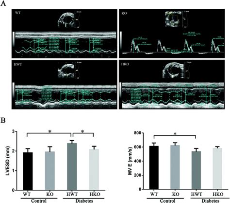 mir 155 regulates high glucose induced cardiac fibrosis via the tgf β signaling pathway